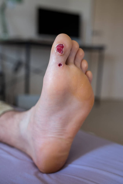 Big toe wound after plantar wart electrocautery surgery. - Photo, Image