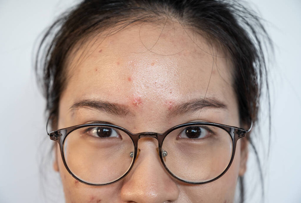 Close up of Asian woman having acne occur on her forehead. Conceptual shot of Acne and Problem Skin on female face. - 写真・画像