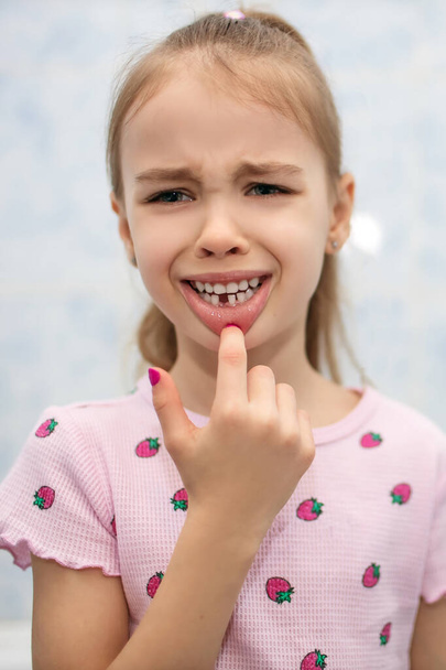 A child girl shows her mouth without one missing milk tooth and suffers pain. The first milk tooth fell out. A suffering child without a front tooth. Milk teeth concept. Preschool dental care - Photo, Image