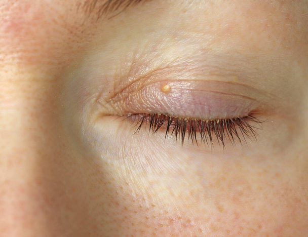 Fat on the eye of a young female woman, a small white wen on the upper movable eyelid. Eye diseases, dermatologist, omentum, itching and pus. Close-up of the girl's closed eye. - Foto, Bild