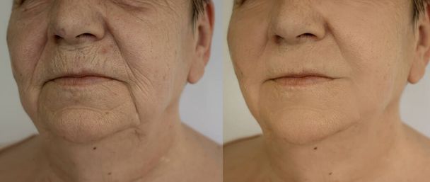 γυναίκα διπλό πηγούνι πριν και μετά από διαδικασίες - Φωτογραφία, εικόνα
