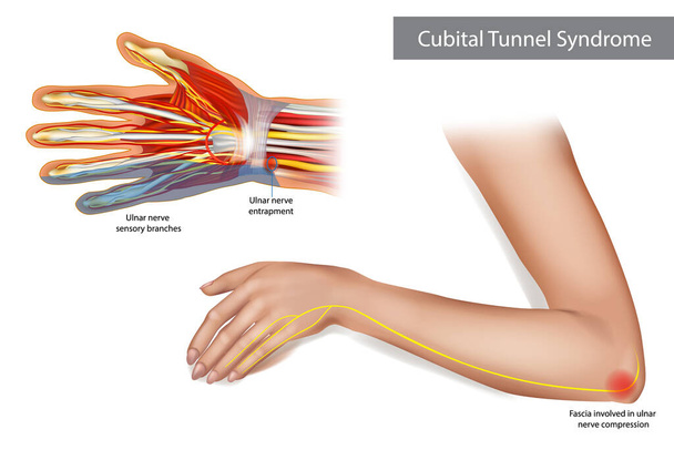 Medical illustration to explain Cubital tunnel syndrome. Ulnar nerve entrapment. Fascia involved in ulnar nerve compression. - Vektor, obrázek