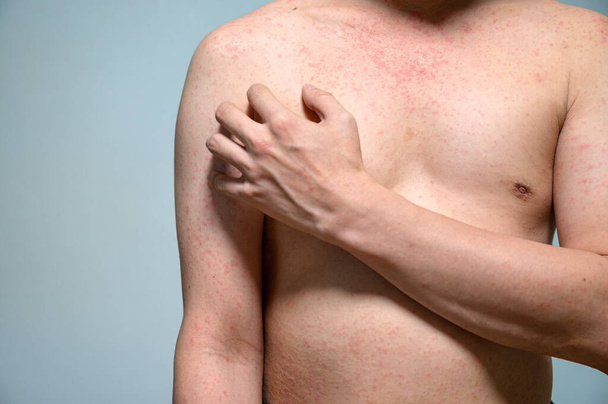 Dermatitis rash viral disease with immunodeficiency on body of young adult asian, scratching with itching, Measles Virus, Viral Exanthem - 写真・画像