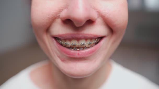 Een glimlachende vrouw met een beugel. Tandheelkundige behandeling en tanden uitlijning concept - Video