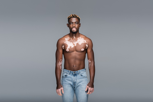 shirtless and muscular african american man with vitiligo skin looking at camera isolated on grey - Fotó, kép