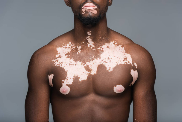 cropped view of shirtless african american man with vitiligo skin and muscular torso isolated on grey - 写真・画像
