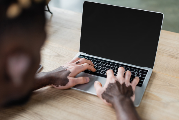 partial view of blurred african american man with vitiligo typing on laptop with blank screen in office - Fotoğraf, Görsel