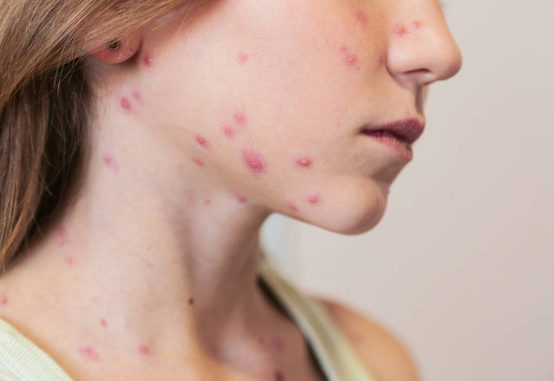 Cute little girl with chickenpox at home. Varicella zoster virus. - Foto, imagen
