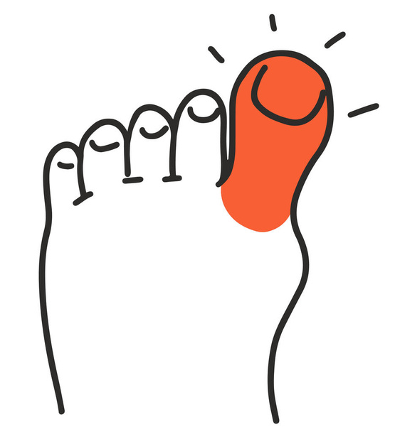 Dor e vermelhidão no dedo grande do pé com gota - Vetor, Imagem