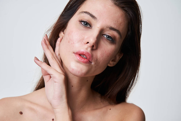 Woman with pretty face and skin imperfections posing fashionably with her hands - Foto, immagini