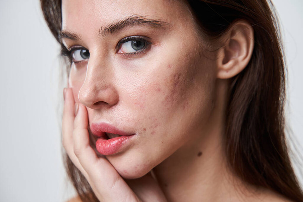 Woman with with post acne spots at her face looking at the camera - Foto, Bild
