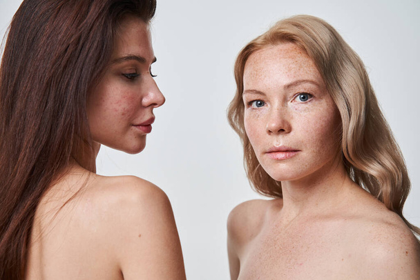 Woman with problematic skin looking at her freckled girlfriend while posing - Foto, afbeelding