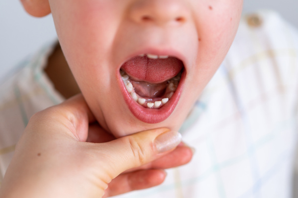 Gyerekek cápa fogak, az első fog, amely megjelenik a gyermekkorban a tejfogak mögött. - Fotó, kép