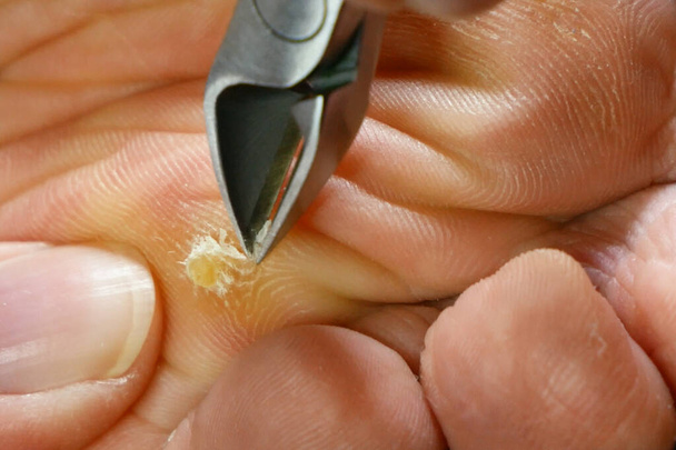 treating feet during procedure, woman removes calluses on her feet at home, cutting out calluses on the heel with nippers at home.  - Photo, Image