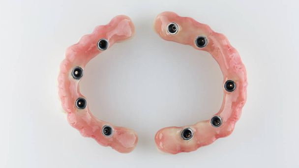 Two ceramic prosthesis on a white background, view from the pink gums - Foto, Imagen