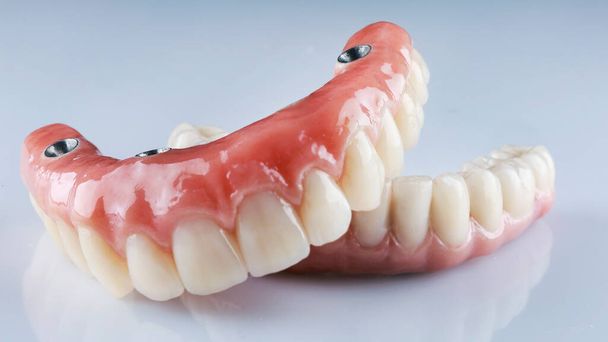 白い背景に歯科用義歯を4本のインプラントに固定し - 写真・画像