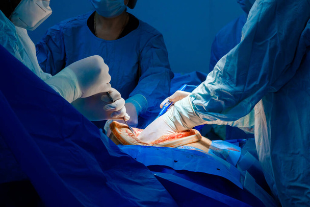 Surgery on the patients abdominal cavity. - Photo, Image