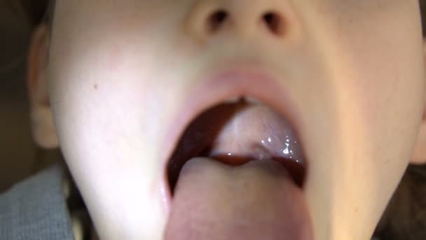 Grande bouche ouverte avec une langue coincée, vue sur la luette et le palais mou de la petite fille, dentisterie pédiatrique - Séquence, vidéo