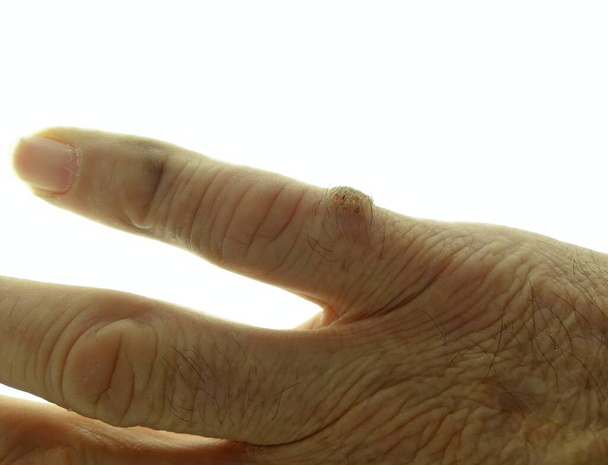 Mão de um homem idoso no fundo branco mostrando uma malformação benigna da pele, uma verruga com pêlos em um dos dedos - Foto, Imagem
