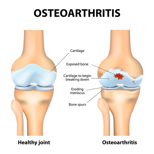 osteoarthritis vagy ízületi gyulladás - Vektor, kép