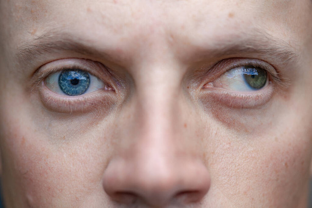 Strabismus mies sekä sokeus toisessa silmässä. synnynnäiset näköhäiriöt. näkövamma. silmätautien käsite - Valokuva, kuva