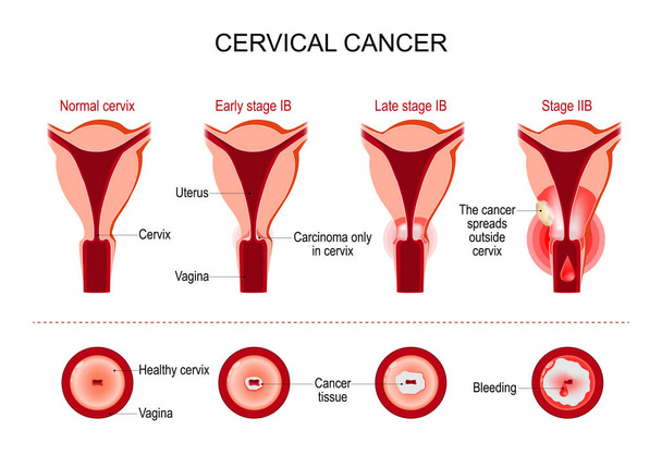 Cervical cancer or cervix carcinoma. development stage. vector illustration - Vetor, Imagem