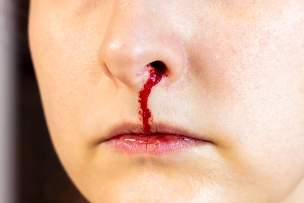 Frauengesicht mit Nasenbluten in Großaufnahme. Blutende Nase mit rotem Blut als Verletzung nach einem Unfall oder Krankheitssymptom. - Foto, Bild