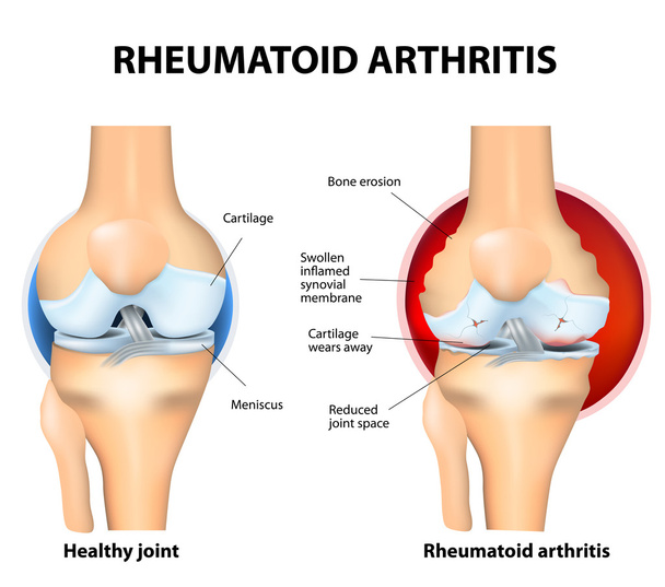 normální kloub a revmatoidní artritida - Vektor, obrázek
