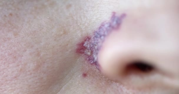 Huidconditie na procedure, verwijdering van het vasculaire netwerk op het gezicht. - Video