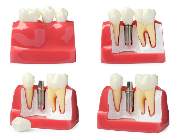 Educational models of gum with dental implant between teeth on white background, collage - Fotó, kép