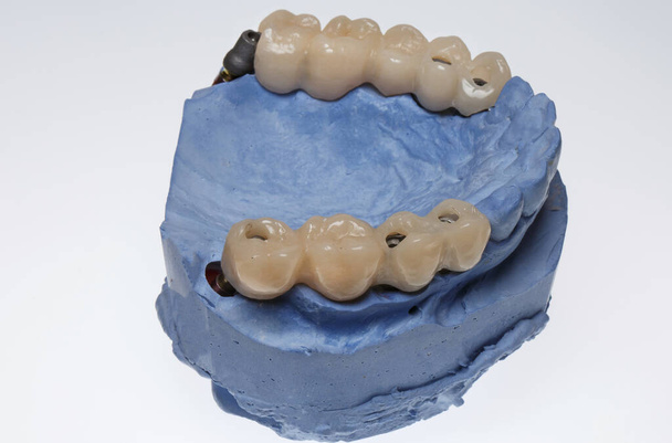 Prótesis dentales temporales después de la implantación de los dientes de mascar del paciente - Foto, Imagen