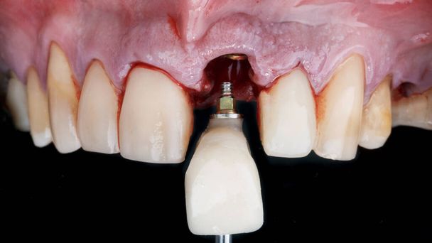 τοποθέτηση της στεφάνης του εμπρόσθιου δοντιού μετά την εμφύτευση - Φωτογραφία, εικόνα