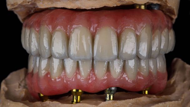 οδοντιατρικές προθέσεις των άνω και κάτω σιαγόνων από τιτάνιο και κεραμικά σε δάγκωμα σε μαύρο φόντο - Φωτογραφία, εικόνα