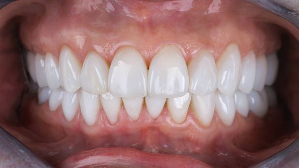 with veneers on the upper and lower jaw in the bite - Photo, Image