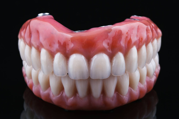 Prótesis dentales cerámicas hechas de cerámica metálica en mordida sobre un fondo negro - Foto, imagen