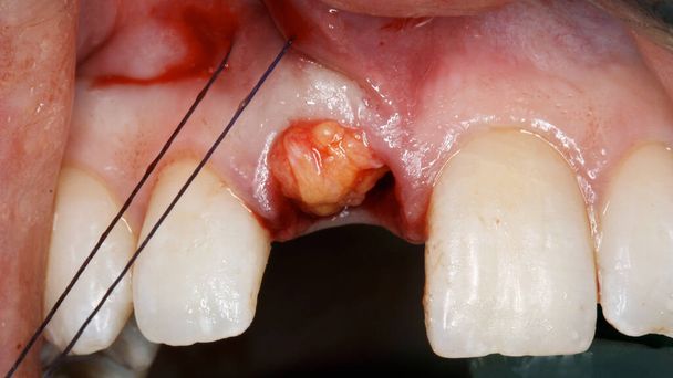 dodanie tkanek miękkich do dziąseł po implantacji stomatologicznej - Zdjęcie, obraz