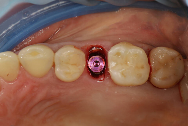 implantantat masticando dientes y su conductor - Foto, Imagen