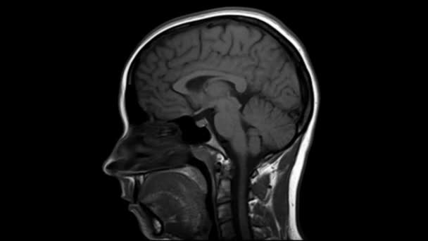 人間の頭部脳MRI画像。サイドビュープロフィール。医療・医療 - 映像、動画