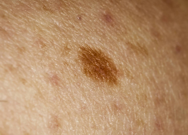 Large mole on human skin. Mole removal concept. Macro photo, selective focus - Photo, Image