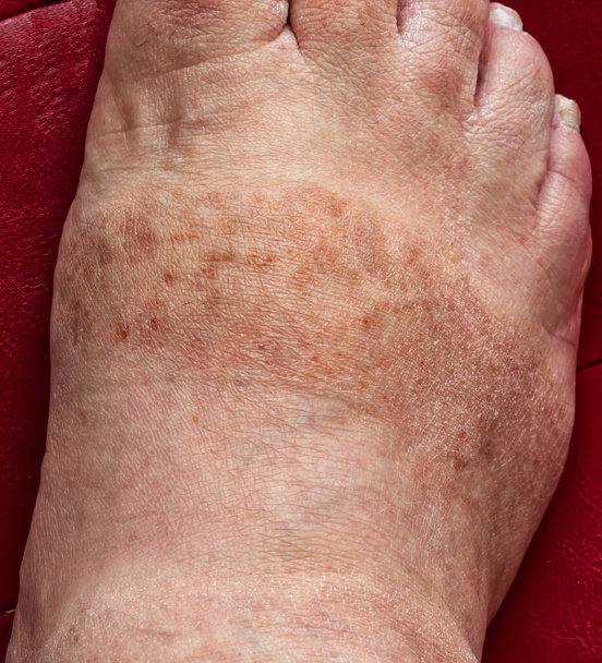 Manchas escuras e pele desidratada no pé do macho. Conceito de problemas dermatológicos. - Foto, Imagem