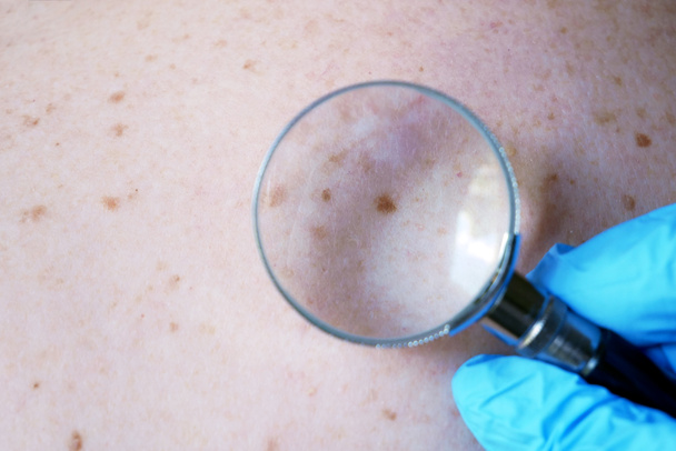 doctor dermatologist examines birthmark of patient. Checking benign moles closeup - Photo, Image