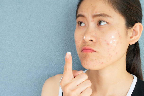 Retrato de mujer con inflamación del acné (pápula y pustula) en la cara y que aplica crema de acné en la cara para el tratamiento. Conceptual de problemas en la piel de la mujer. - Foto, Imagen