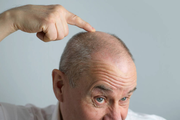 close-up old bald charismatic mature man showing his hair fall from head, patient with alopecia in hair growth clinic, topic of hair loss in men, selective focus. Anti-aging treatments for balding men - Valokuva, kuva