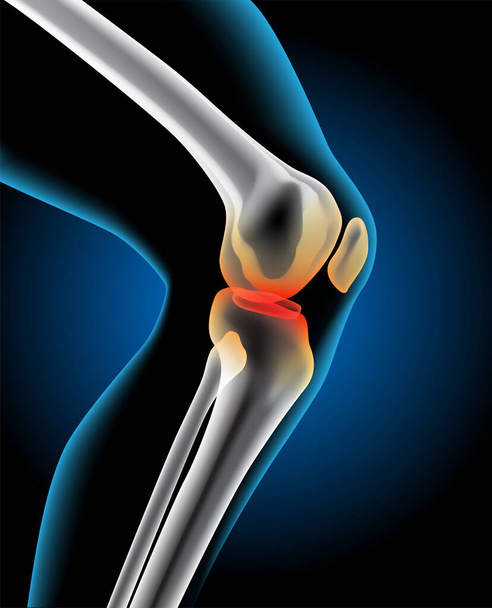 La foto mostra una lesione all'articolazione del ginocchio. - Vettoriali, immagini