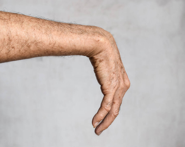 Lésion nerveuse radiale ou chute du poignet de l'homme âgé asiatique. - Photo, image