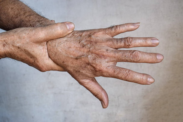 Asyalı yaşlı adamın ellerinde yaş lekeleri var. Bunlar kahverengi, gri veya siyah noktalardır ve ayrıca karaciğer lekeleri, bunak mercimek, güneş mercimeği veya güneş lekeleri olarak da adlandırılır.. - Fotoğraf, Görsel