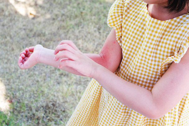 Petite fille a une éruption cutanée allergie et démangeaisons sur son bras - Photo, image