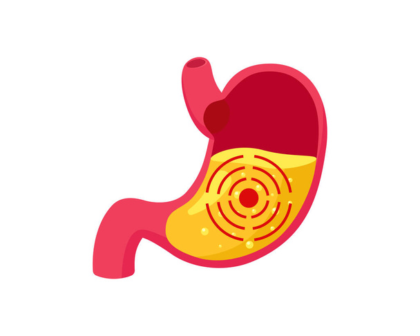 胃の中に胃ジュースと胃潰瘍とターゲット。消化器系胃炎の問題.消化不良と腹病.腹部の胃の痛み.医用ベクターイラスト - ベクター画像
