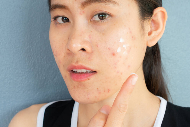 Porträt einer Frau mit Akne-Entzündung (Papel und Pustule) im Gesicht, die zur Behandlung Akne-Creme auf ihr Gesicht aufträgt. Konzeptionelle Probleme auf der Haut von Frauen. - Foto, Bild
