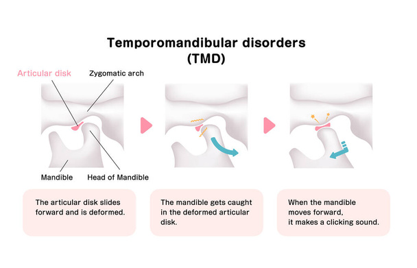 A temporomandibularis betegségek (TMD) okának illusztrációja) - Vektor, kép